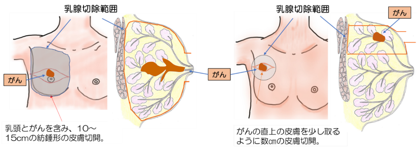 乳房に対する手術