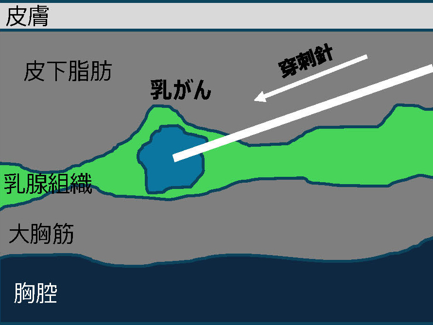 化学療法の内訳