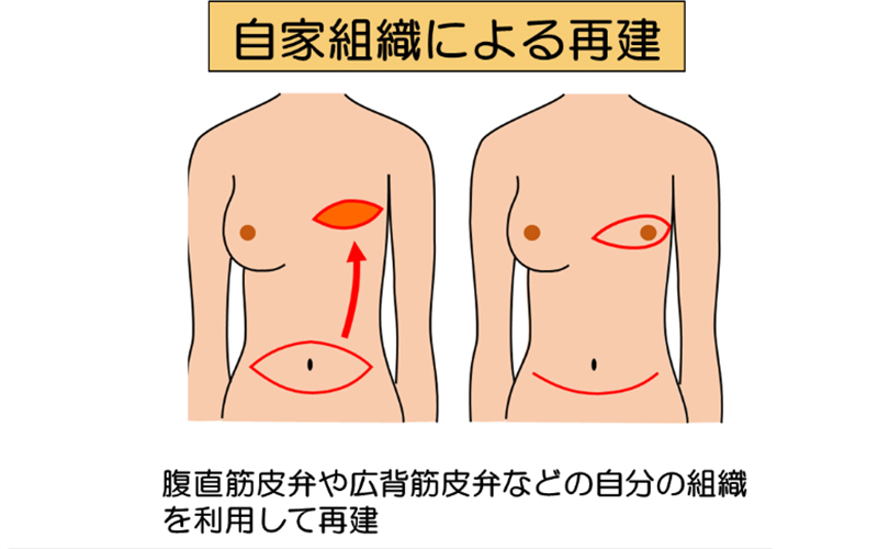 乳房再建