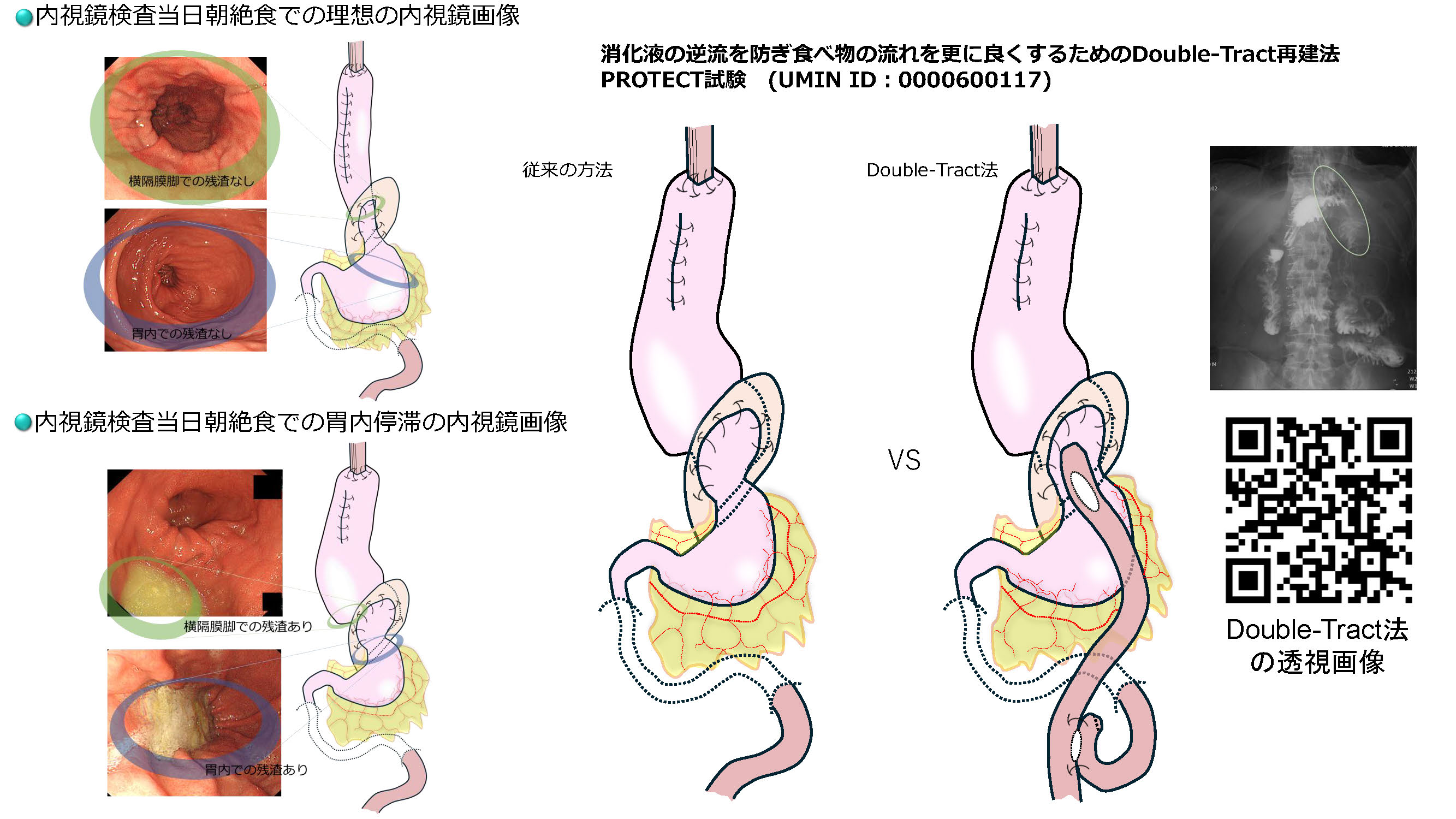 精緻な手術の追求