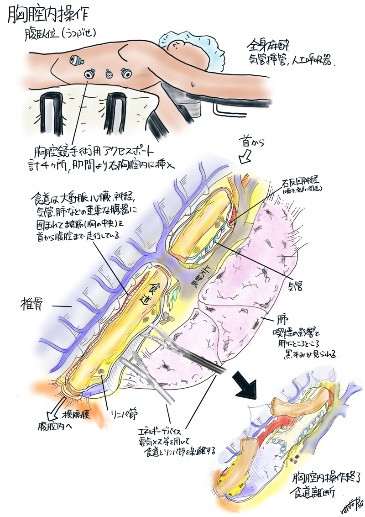 食道手術①