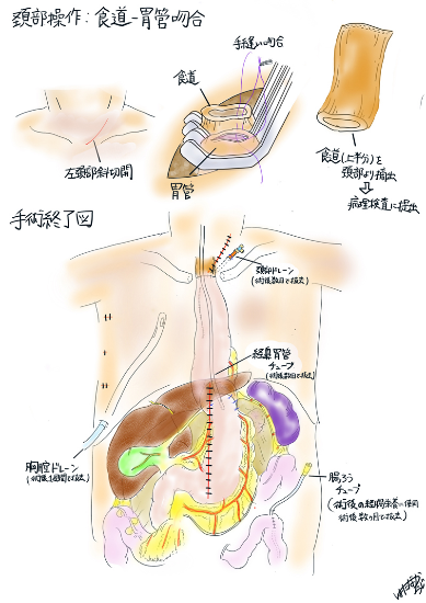 食道手術③