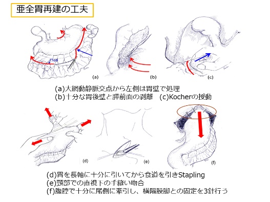 亜全胃再建の工夫