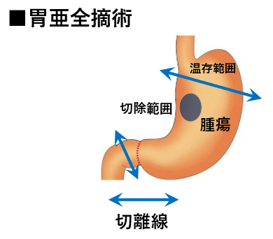 亜全胃の血流