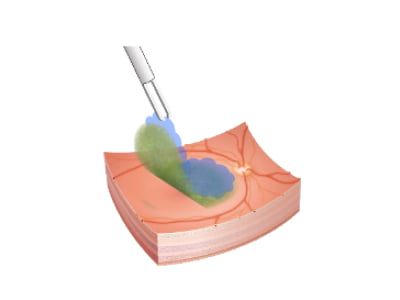 現在当科で産学連携共同研究にて開発中の新規硝子体手術用補助剤の使用イメージ図