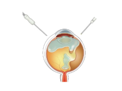 裂孔原性網膜剥離に対する硝子体手術のシェーマ