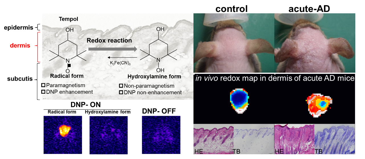 アトピー性皮膚炎モデルのDNP-MRIによる早期レドックス変動の可視化