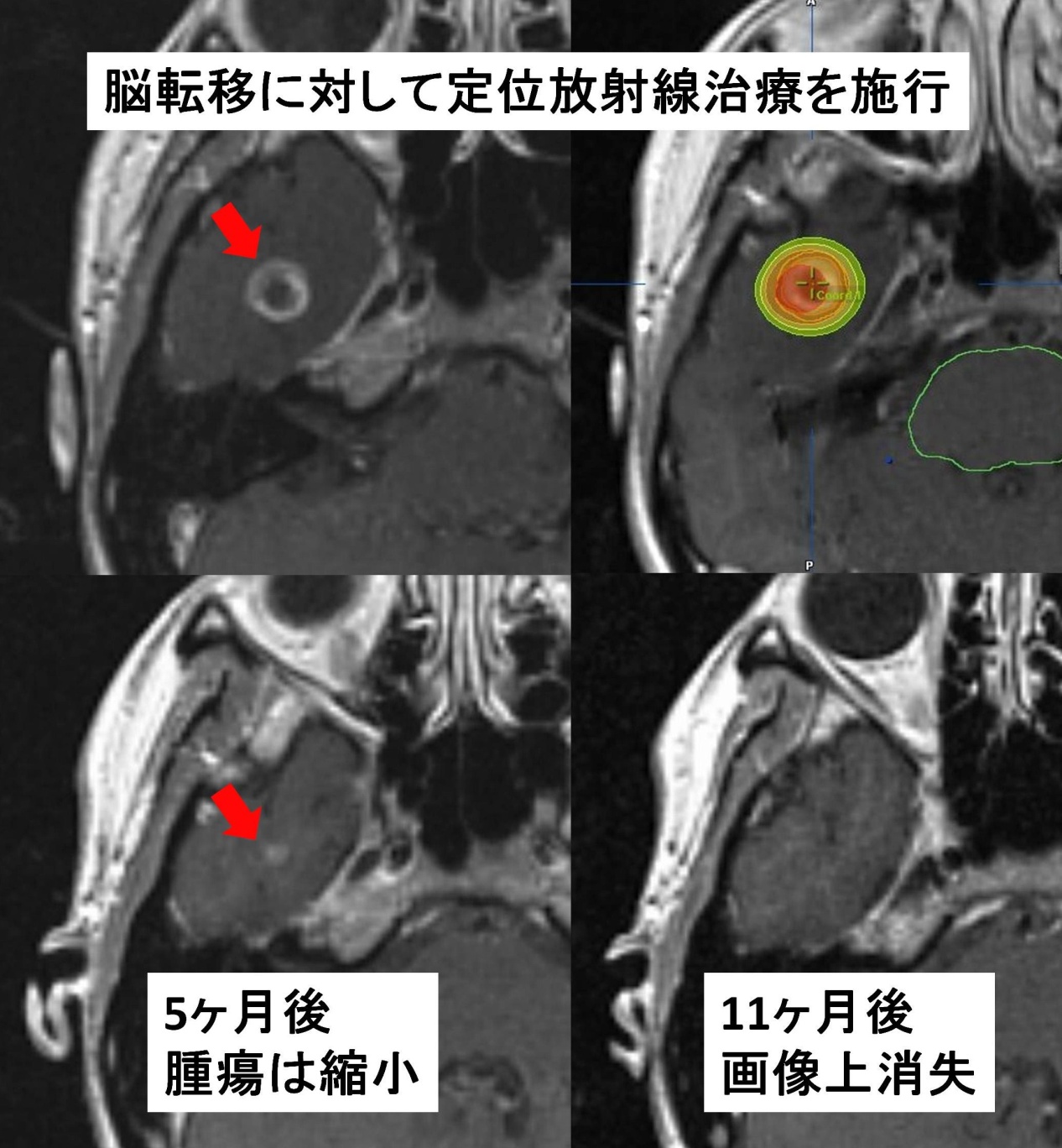 定位放射線治療（SRS/SRT）