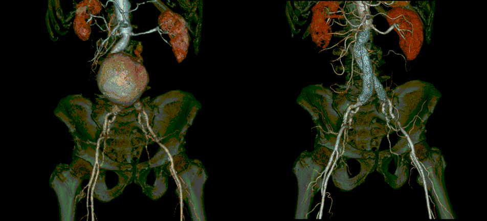 腹部および胸部大動脈瘤に対するステントグラフト内挿術